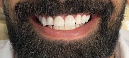 Results — Lamazi